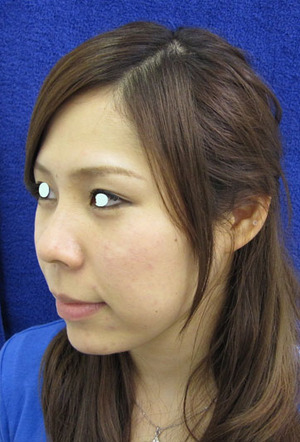 目の下のたるみ、目のくまでお悩みの方、切らずに完璧に解決します。TCB-R法　手術直後　症例写真